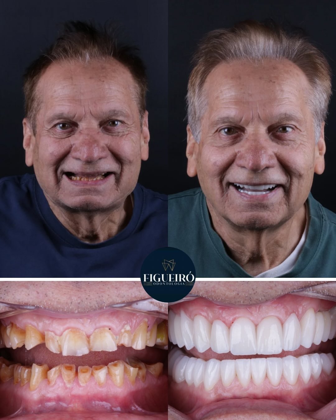 Lentes em porcelana na Figueiró Odontologia