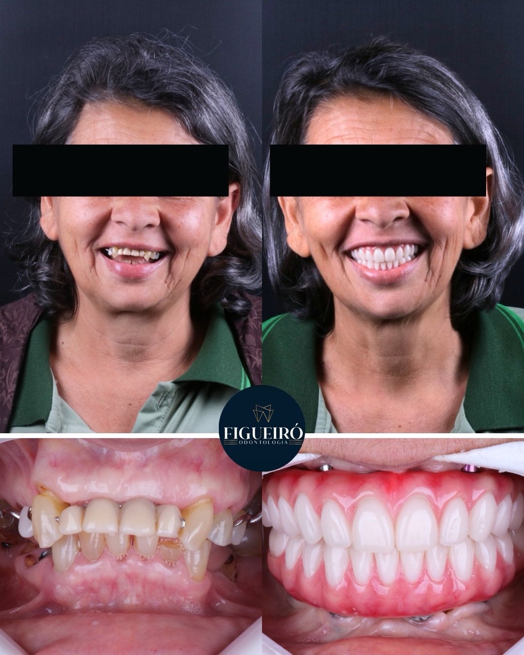 Reabilitação oral na Figueiró Odontologia