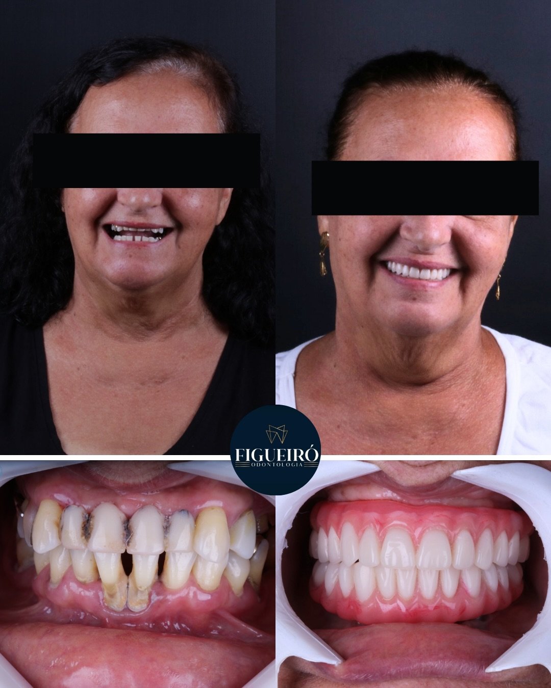 Implantes dentários na Figueiró Odontologia